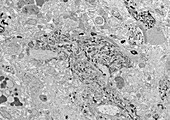 Amyloid plaque, TEM