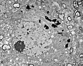 Neuron in Alzheimer's disease, TEM