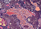 Amyloid plaque, TEM