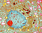 Neuron in Alzheimer's disease, TEM