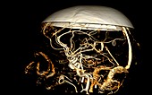 Blood vessels of the brain, 3D CT scan