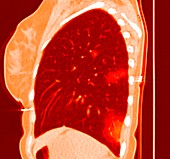 Lung affected by Covid-19 pneumonia, CT scan