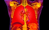 Healthy lungs, 3D CT scan