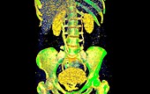 Urinary system with duplicated ureter, 3D CT scan