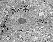 Nerve cell in Alzheimer's disease, TEM