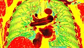 Pulmonary embolism, 3D CT scan