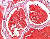 Multilocular cystic renal neoplasm, light micrograph