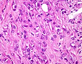 Clear cell renal cell carcinoma, light micrograph