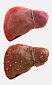 Health liver and cirrhotic liver, illustration