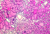 Thyroid nodule, light micrograph