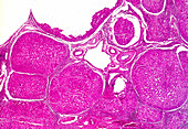 Liver cirrhosis in Wilson's disease, light micrograph