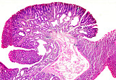 Duodenal polyps, light micrograph