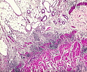 Crohn's disease, light micrograph