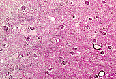 Membranous glomerulonephritis, light micrograph