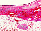 Dermoid ovarian cyst, light micrograph