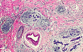 Pyogenic granuloma, light micrograph