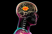 Brain mucormycosis, illustration