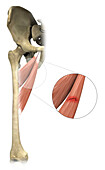 Adductor muscle strain, illustration