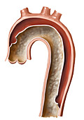 Aortic dissection, illustration