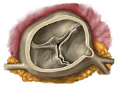 Moderate narrowing of the aortic valve, illustration