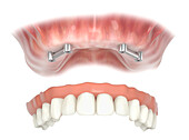 Bar retained denture, illustration
