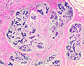 Breast fat necrosis, light micrograph