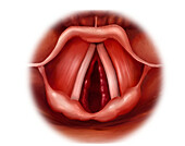 Subglottic laryngitis, illustration