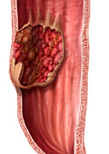 Oesophageal cancer, illustration