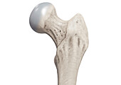 Femoral neck and head, illustration
