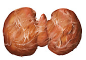 Riedel's thyroiditis, illustration