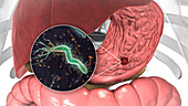 Gastric ulcer and Helicobacter pylori bacteria, illustration