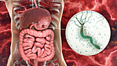 Gastric ulcer and Helicobacter pylori bacteria, illustration