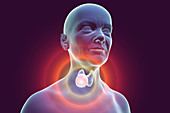 Thyroid gland tumour, illustration