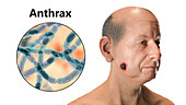 Cutaneous anthrax, illustration