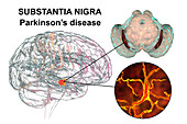 Substantia nigra in Parkinson's disease, illustration