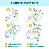Bariatric surgery types, illustration