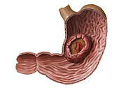 Ulcerated cancer in the stomach, illustration