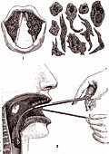 Laryngeal cancer, 19th century illustration