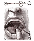 Tonsillectomy, 19th century illustration