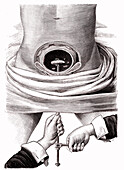 Bladder stone removal, 19th century illustration