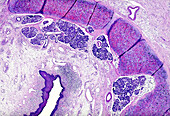 Throat cancer, light micrograph