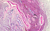 Tracheobronchial tumour, light micrograph