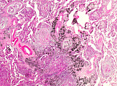 Pulmonary tuberculosis, light micrograph
