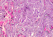 Neuroendocrine tumour of the lung, light micrograph
