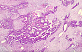 Pleural mesothelioma, light micrograph