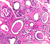 Adenoid cystic carcinoma, light micrograph