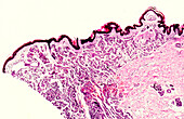 Ataxia- telangiectasia, light micrograph