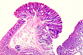 Familial adenomatous polyposis, light micrograph
