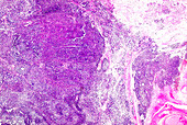 Extragonadal germ cell tumour, light micrograph