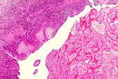 Penile cancer, light micrograph
